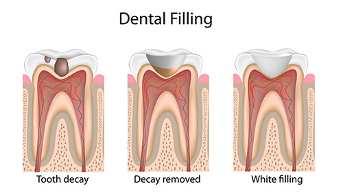 Dental fillings graphic