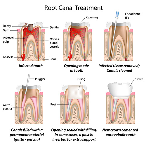 Root canal treatment graphic