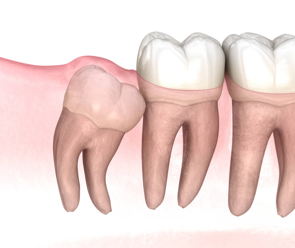 wisdom tooth extraction Perth