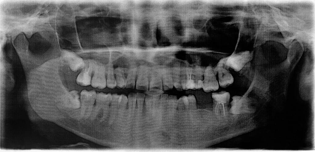 Perth wisdom tooth removal