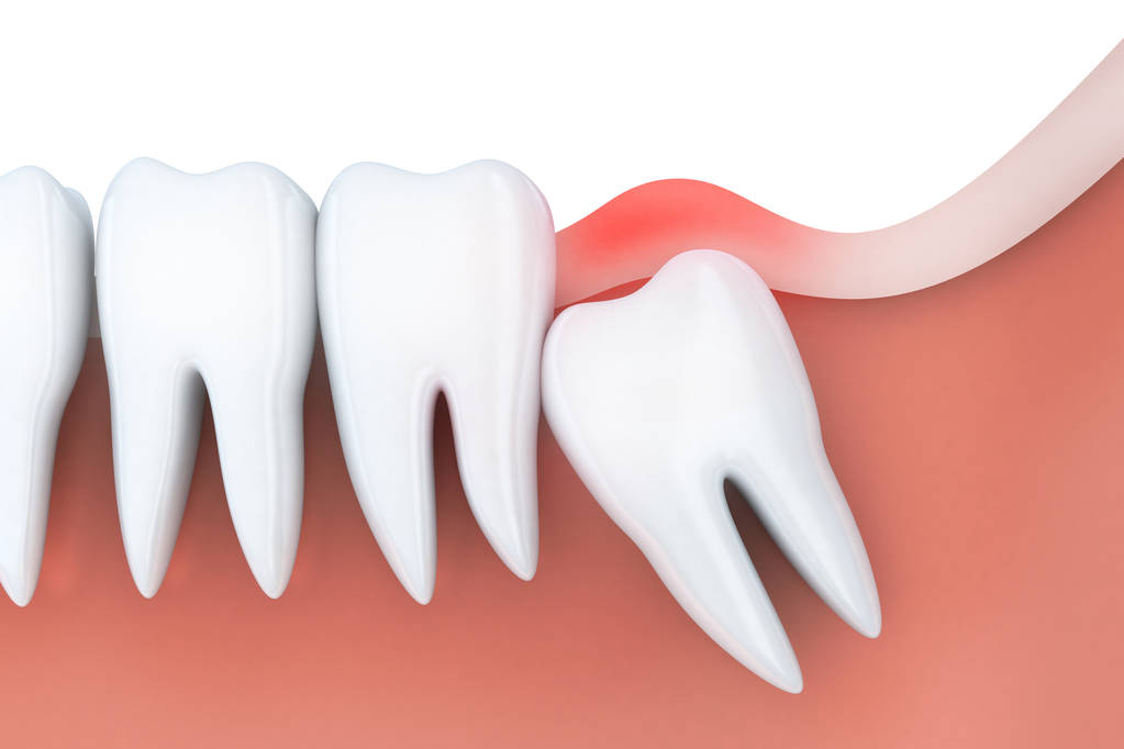 wisdom teeth removal Perth cost