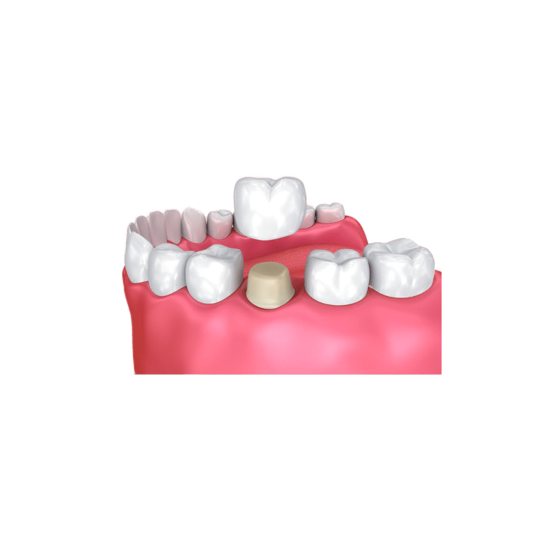 Dental Crowns Perth