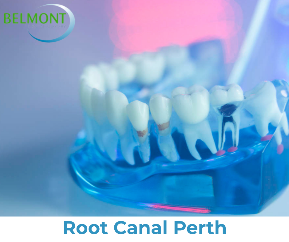 Cheap Root Canal Perth